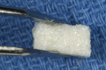 Figure 19  An amalgam condenser was used to pack the bone graft material against the abutment into the gap, filling the bone and tissue zones. Note that the bone graft material occupies the tissue zone to the height of the FGM.