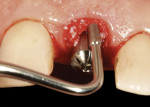 Figure 20  An amalgam condenser was used to pack the bone graft material against the abutment into the gap, filling the bone and tissue zones. Note that the bone graft material occupies the tissue zone to the height of the FGM.