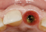 Figure 25  At first abutment disconnection, the non-keratinized sulcular epithelium was observed to be healthy, and particles of xenograft material can be seen within the peri-implant soft tissues. Excellent bucco-lingual volume seems to be coinciden