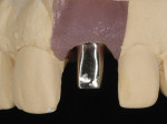 Figure 27  The soft-tissue cast allowed a screw-retained custom abutment to be constructed with a gold alloy. The advantages of a custom abutment are controlling the soft-tissue profile with the abutment, not the crown, as well as the vertical depth