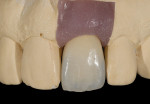 Figure 28  The definitive metal-ceramic crown on the soft-tissue cast with the proper sub- and supragingival contours.