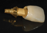 Figure 29  The metal-ceramic crown and gold alloy abutment were gold plated with gold-plating solution.
