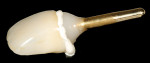 Figure 32  Once the crown was filled with cement and seated extraorally, the excess cement was easily visualized and cleaned off completely prior to intraoral insertion.