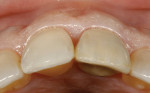 Figure 34  Intraoral three-quarter occlusal view of implant tooth No. 9 shows ridge contour shape equivalent to that of untreated contralateral central incisor tooth No. 8.