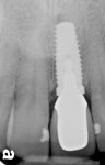Figure 35  Definitive periapical radiograph showing the osseous crest to the head of the platform-switched (5-4) implant No. 9. Bone particles can still be seen 8 months post-implant placement in the soft-tissue profile, which helps to support the pe