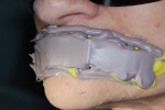 Figure 3  A facial moulage was taken to determine lip proportion for the edentulous patient.
