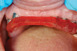 Figure 11  The verification index was placed in the mouth to check implant placement.