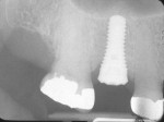 Figure 16 An implant was placed at
the time of molar extraction, with concomitant regenerative therapy. A 1-year post-therapy radiograph demonstrated excellent osseous fill
in the residual extraction socket defect.