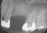Figure 2 Following tooth extraction, implosion of the interradicular bone, and use of appropriate regenerative materials, a 6-month radiograph demonstrated bone regeneration and preservation of the bone protecting the entrance to the mesial furcation of the second molar.