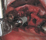 Figure 8 After the interradicular bone osteotomy was expanded to 3.5 mm, implant insertion of a tapered end implant with a 4.1-mm base and a 6.5-mm restorative platform was begun using a handpiece carrier at 30 rpm.