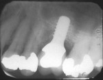 Figure 4 A radiograph taken 8+ years in function demonstrated stable peri-implant crestal bone.