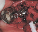 Figure 9 The implant was inserted to the appropriate depth.