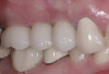 Fig 16. Intraoral frontal photograph 2 years after completion of treatment. The severe posterior bilateral crossbite was corrected, the width discrepancy between the upper and lower arches was fully addressed, and the lower buccal segments were uprighted through the use of buccal shelf miniscrews. Good class I molar and canine relation with adequate overjet and overbite was achieved. Note that the upper right lateral incisor had a minor relapse, which may have been due to insufficient root torque during fixed orthodontics. In a critical evaluation of the case, more opposite-torque correction in the upper right lateral incisor and cuspid might have been beneficial.