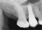 Figure 17 A 6-year post therapy radiograph demonstrated stability of the peri-implant crestal bone.