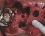 Figure 7 A view of the interradicular bone in the first molar area following use of the 2.2-mm-wide osteotome. Note the 3.5-mm-wide osteotomy in the second bicuspid site.