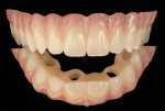 Figure 28 Completed provisional restoration created preoperatively.