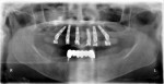 Figure 30 Postoperative panoramic radiograph, immediate load with provisional restoration.