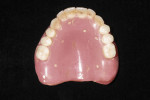 Figure 2 Hard relined maxillary denture, gutta percha fiducial markers inserted.