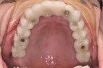 Figure 32 Provisional restoration in place, occlusal view.