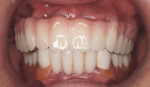 Figure 31 Provisional restoration in place,
immediately after implant surgery.