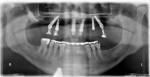 Figure 7 Postoperative panoramic radiograph. Note healing abutment on implant maxillary left posterior implant site, not immediately loaded.