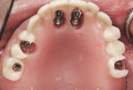 Figure 8 Maxillary denture adjusted and retrofitted to allow for titanium abutments to be embedded with light-cured acrylic resin.