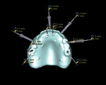 Figure 3 Virtual treatment plan: six implants, angled abutments in place.