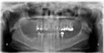 Figure 10 Patient 2. Preoperative panoramic radiograph prior to extractions.