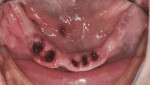 Figure 14 Minimally traumatic teeth extractions.
