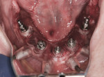 Figure 15 Five implants placed, fully guided using implant mounts.