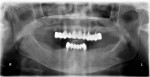 Figure 20 Patient 3. Initial evaluation, panoramic radiograph.