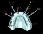 Figure 22 Virtual treatment plan: six implants planned, abutments in place, occlusal view.