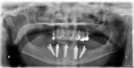 Figure 18 Immediate postoperative
panoramic radiograph.