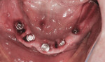 Figure 16 Five implants in place, surgical guide removed, abutments in place.