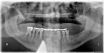 Figure 1 Patient 1. Preoperative radiograph, fully edentulous maxilla.