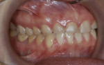 Figure 3   Erosion of maxillary and mandibular teeth and compensatory eruption resulted in gingival and occlusal plane asymmetry and disharmony—right side (Fig 3); left side (Fig 4).