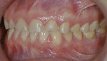 Figure 4   Erosion of maxillary and mandibular teeth and compensatory eruption resulted in gingival and occlusal plane asymmetry and disharmony—right side (Fig 3); left side (Fig 4).
