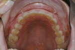 Figure 5  Erosion of all maxillary teeth; the most extensive damage was on the lingual surfaces of the anterior teeth.