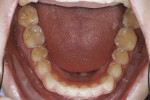 Figure 6  Eroded tooth structure surrounding the existing composite restorations.