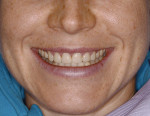 Figure 11  Close evaluation of the provisional restorations assured that they met the desired esthetic and functional needs of the patient.