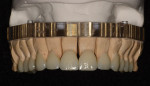 Figure 12   The e.max lithium disilicate crowns on the master model.