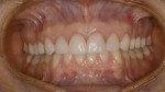 Figure 13  The definitive restorations reflected the length, contour, and arrangement established with the provisional restorations.