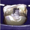 Fig 2. Intraoral camera view of custom contoured healing abutments placed to establish an ideal emergence profile.