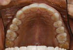 Figure 16  The restored maxillary arch addressed the biomechanical risk.