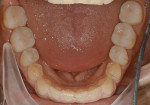 Figure 17  The mandibular arch showing the composite onlays to be stable and functional.