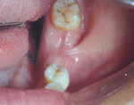 Figure 2  Clinical occlusal view showing the fan-shaped buccinator attachment.