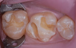 Figure 3 Defective restorations were removed
and the preparations refined.