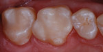 Figure 7 Postoperative view of the posterior
direct composite restorations.