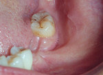 Figure 3  Clinical buccal view showing the fan-shaped buccinator attachment.