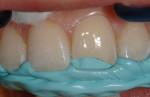 Figure 12 An incisal edge index was made from a light-body bite registration material.